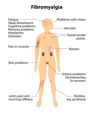 Fibromyalgia symptoms pain locations